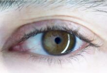 Photo of आंखाें के सामने नजर आ रहे काले धब्बे? Eye Cancer हो सकता है कारण