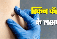 Photo of स्किन कैंसर का शुरुआती लक्षण है लंबे समय तक घाव का न भरना