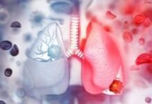 Photo of जहरीली हवा से बढ़ रहा फेफड़ों की इस गंभीर बीमारी का खतरा