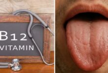 Photo of जीभ पर दिखते हैं विटामिन-B12 की कमी के 3 बड़े संकेत