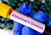 Photo of लक्षण दिखने से 10 साल पहले ही पता चल सकेगा अल्जाइमर का खतरा