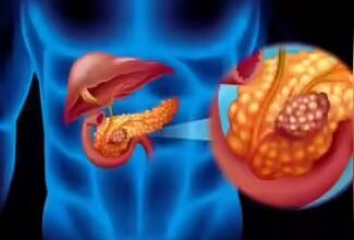Photo of जल्दी पहचान में नहीं आते पैंक्रियाटिक कैंसर के लक्षण