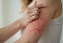 Photo of जिसे साधारण एलर्जी समझ रहे हैं, कहीं वो अर्बन आई सिंड्रोम तो नहीं?