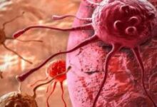 Photo of सिर्फ बुजुर्ग नहीं, अब युवाओं को भी शिकार बना रहा है कैंसर