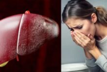 Photo of त्वचा पर नजर आते हैं लिवर की खराबी के 5 लक्षण